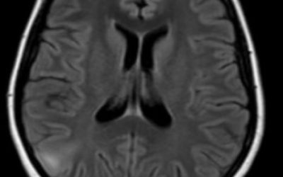 Focal Cortical Dysplasia Epilepsy patient MRI with focal cortical dysplasia