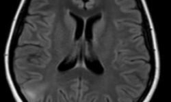 Focal Cortical Dysplasia Epilepsy patient MRI with focal cortical dysplasia