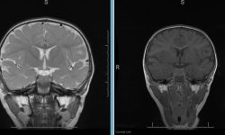 Focal Cortical Dysplasia Epilepsy patient MRI with focal cortical dysplasia