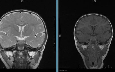 Focal Cortical Dysplasia Epilepsy patient MRI with focal cortical dysplasia