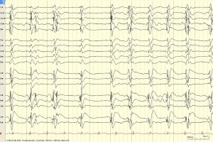Generalized Periodic Discharges (GPDs) Generalized periodic discharges on bipolar EEG