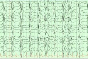 Generalized Periodic Discharges (GPDs) EEG tracing with Generalized periodic discharges (GPDs)