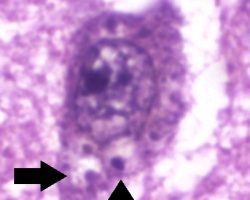 Granulovacuolar degeneration HIgh power H&E image showing intraneuronal accumulations of large vacuoles harboring a central granule. consistent with granulovacuolar degeneration