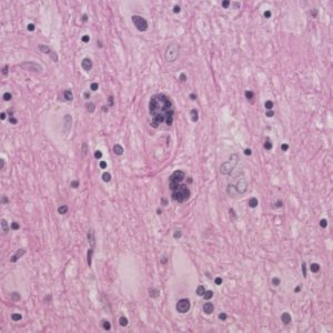 HIV Leukoencephalopathy HIV Leukoencephalopathy H&E stain showing gliotic white matter with two multinucleated cells, consistent with HIV encephalitis