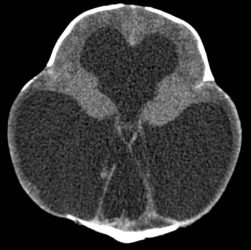 Aqueductal Stenosis Aqueductal stenosis causing severe obstructive hydrocephalus on CT head