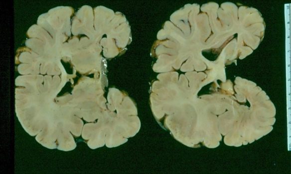 Hemimegalencephaly Gross neuropathologic coronal brain sections showing hemimegalencephaly