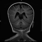 Heterotopia Subependymal nodular heterotopias on an MRI coronal section in a patient with epilepsy