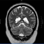Nodular Heterotopia epilepsy patient with nodular heterotopia on coronal MRI brain