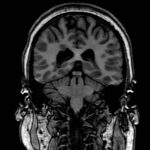 Nodular Heterotopia epilepsy patient with nodular heterotopia
