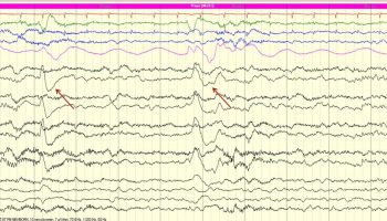 Hiccup Artifact Neonatal EEG with hiccups artifact