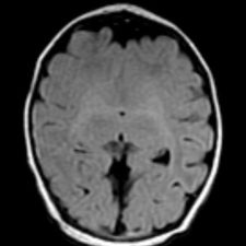 Holoprosencephaly Axial FLAIR MRI showing partial fusion of the frontal lobes with an absence of the falx and septum
