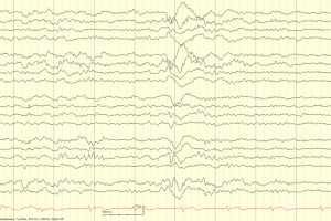 Stage N2 Sleep with K-complex EEG tracing showing a K complex during stage N2 sleep