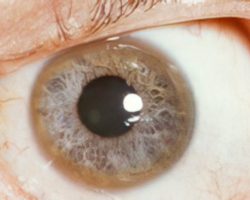 Reddish-green ring on the outer circumference of the cornea, consistent with a Kayser-Fleischer ring. By Herbert L. Fred, MD, Hendrik A. van Dijk, CC BY 3.0, via Wikimedia Commons https://commons.wikimedia.org/wiki/File:Kayser-Fleischer_ring.jpg Neurology Pathology Exam Review Kayser-Fleischer ring