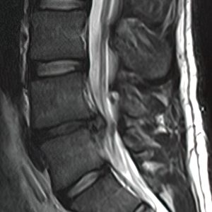 L4-L5 Disc Herniation Sagittal MRI showing L4-L5 Disc Herniation