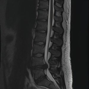 L4-L5 Disc Herniation Sagittal MRI spine showing L4-L5 Disc Herniation