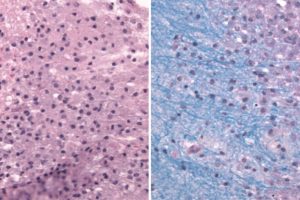 Multiple Sclerosis Plaque Multiple Sclerosis Plaque H&E stain, Low power view, showing sharply demarcated hypocellular plaques