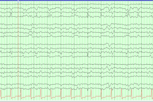 Left Hemispheric Lateralized Periodic Discharges (LPDs) EEG with Left hemispheric lateralized periodic discharge (LPDs)