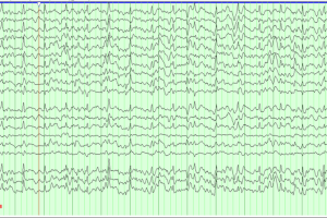 Left Lateralized periodic discharges (LPDs) Read EEG: EEG with Lateralized periodic discharges (LPDs)