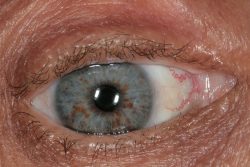 Lisch nodules Lisch nodules Neurofibromatosis type I (NF1)