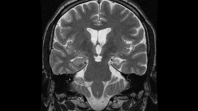 Left Mesial Temporal Sclerosis Coronal MRI with Left mesial temporal sclerosis
