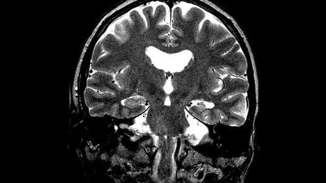Left Mesial Temporal Sclerosis Coronal MRI with Left mesial temporal sclerosis