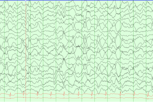 Stage N3 Sleep EEG showing stage N3 slow wave sleep on average montage