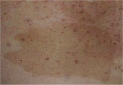 Cafe Au Lait Spot Cafe Au Lait Spot in Neurofibromatosis Type 1 (NF1) gross pathology sample for neurology board review