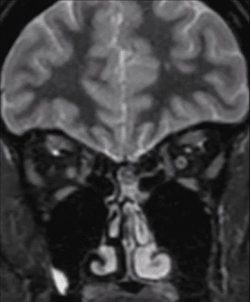 Target Sign of the Left Optic Nerve Coronal brain MRI with contrast showing the target sign of the left optic nerve in a patient with optic neuritis