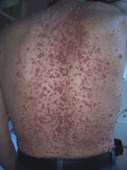Cutaneous Neurofibromas Neurofibramatosis type 1 cutaneous neurofibromas