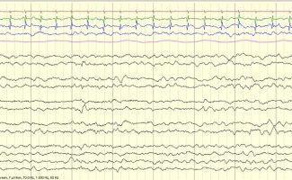 Normal Full-term Neonatal EEG Normal Full-term Neonatal EEG