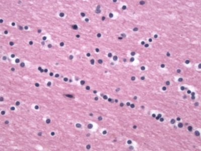 Normal Oligodendrocyte Normal Oligodendrocyte on pathology stain