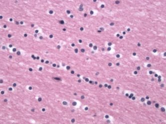 Normal Oligodendrocyte Normal Oligodendrocyte on pathology stain