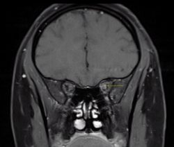 Optic Neuritis Optic Nerve enhancement MOG MRIorbits coronal postcon neuro practice exam
