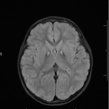 Pantothenate Kinase Deficiency / Hallervorden-Spatz Syndrome Axial MRI, T2 FLAIR, showing increased T2 signal in the bilateral globus pallidi, consistent with iron deposition in Pantothenate Kinase Deficiency