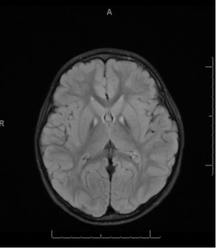 Pantothenate Kinase Deficiency / Hallervorden-Spatz Syndrome Axial MRI, T2 FLAIR, showing increased T2 signal in the bilateral globus pallidi, consistent with iron deposition in Pantothenate Kinase Deficiency