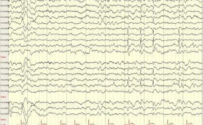 Occipital Sharps in a Patient with Panayiotopoulos Syndrome EEG tracing of a patient with Panayiotopoulos syndrome showing occipital sharps
