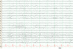 Rhythmic Mid-temporal Theta of Drowsiness (RMTD) EEG with Rhythmic Mid-temporal Theta of Drowsiness (RMTD) in bipolar montage