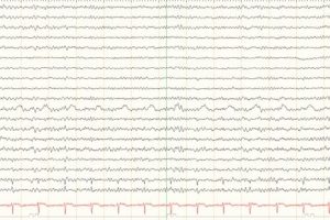 Pulse Artifact Pulse artifact on EEG tracing