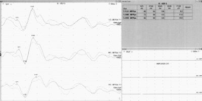Normal visual evoked potential of the left eye Normal visual evoked potential of the left eye