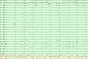 REM Sleep EEG showing REM sleep with muscle atonia