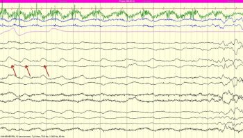 Sucking Artifact Sucking Artifact on EEG tracing