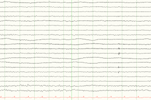 Roving Eye Movements Lateral roving eye movements on EEG tracing