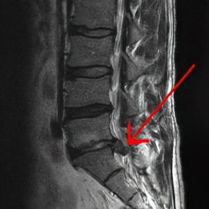 S1 Disc Herniation Sagittal MRI spine showing S1 Disc Herniation