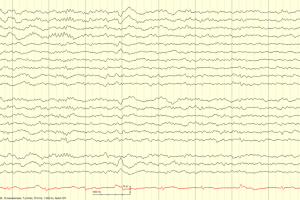 Stage N2 Sleep with Sleep Spindle. Sleep spindle seen on a normal EEG tracing in stage N2 sleep