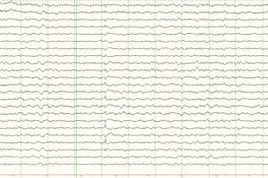 Small Sharp Spike (SSS) Small sharp spike on EEG tracing