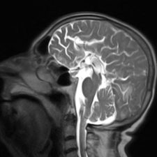 Agenesis of the Corpus Callosum Sagittal MRI showing agenesis of the corpus callosum