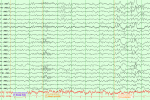 Stage N2 Sleep EEG with stage N2 sleep with sleep spindles and k-complexes