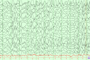 Stage N3 Sleep EEG showing Stage N3 slow wave sleep on average montage