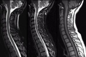 Sagittal spinal MRI of a patient with multiple sclerosis
