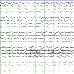 Triphasic Waves Secondary to End-stage Renal Disease EEG with Triphasic waves on bipolar montage